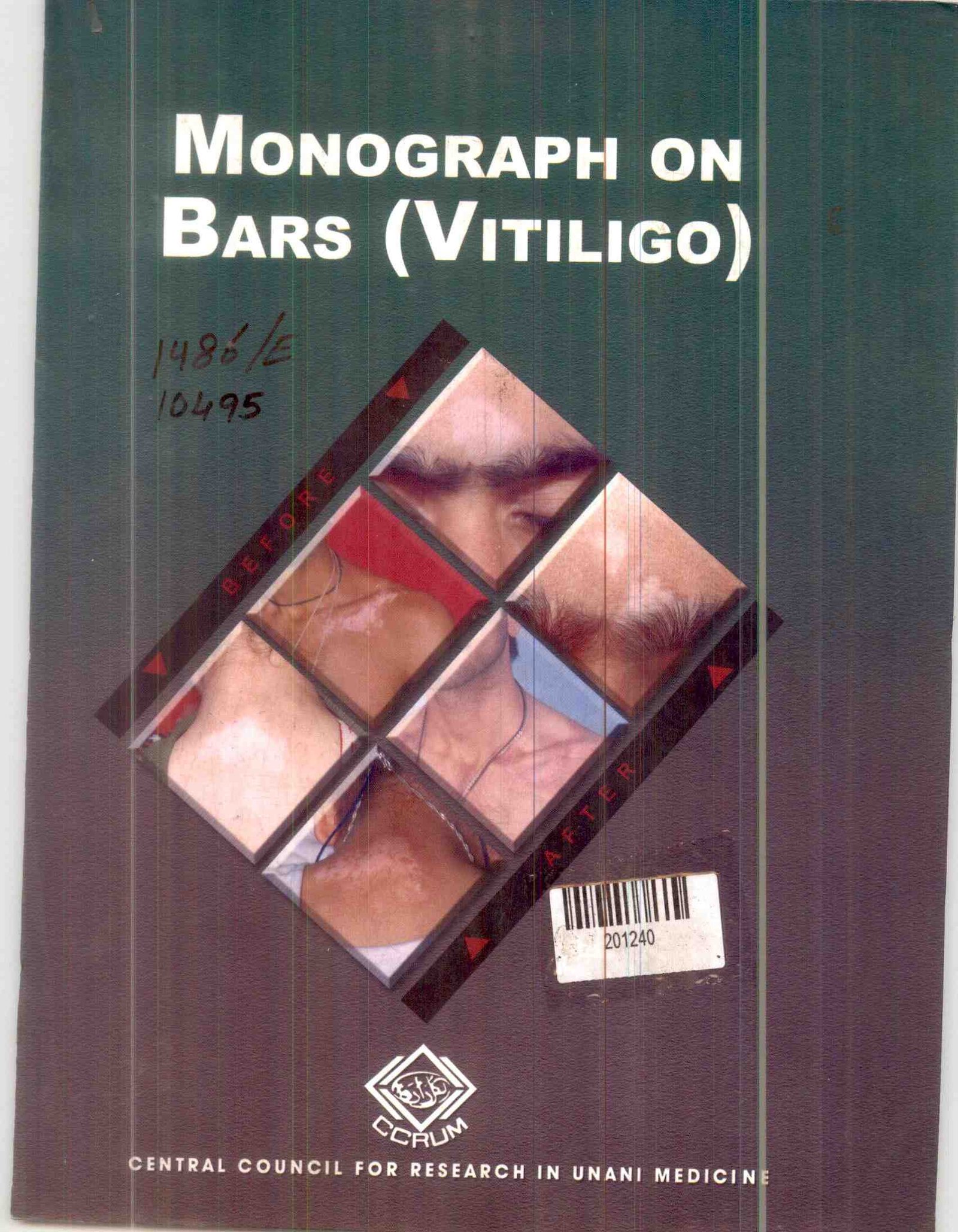Monograph on Bars (vitiligo)